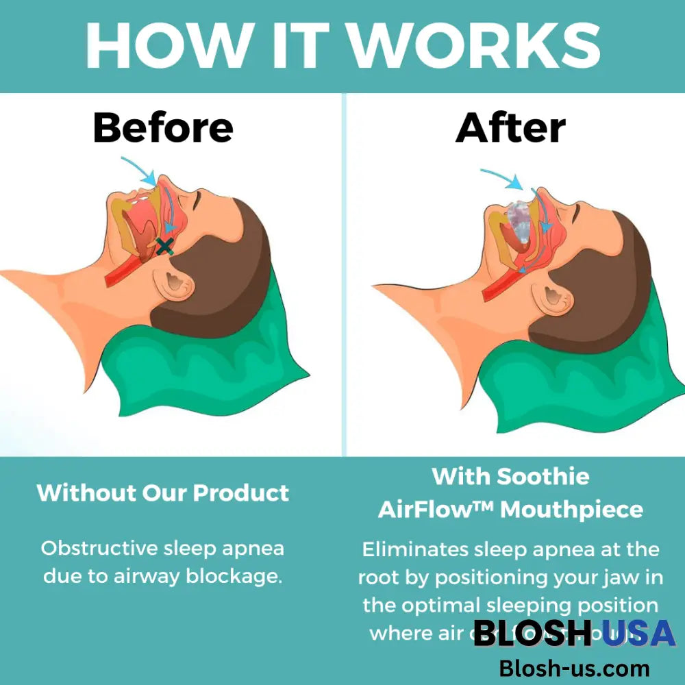 Airflow Anti-Snore Mouthpiece – Soothie